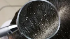 Vergeet dure shampoos en chemicaliën: bestrijd roos met een ingrediënt dat je al in huis hebt