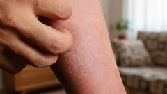 Microscopische monsters van dichtbij: wie verstoppen zich onder je huid en hoe herken je ze?